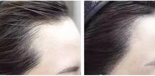 种植发际线需要多少钱		