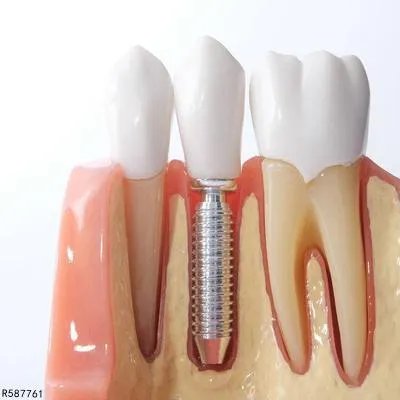 纯钛烤瓷牙需要多少钱