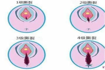 顺产撕裂一度到4度图