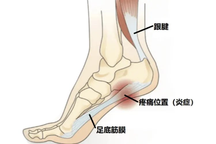 脚痛的位置图片