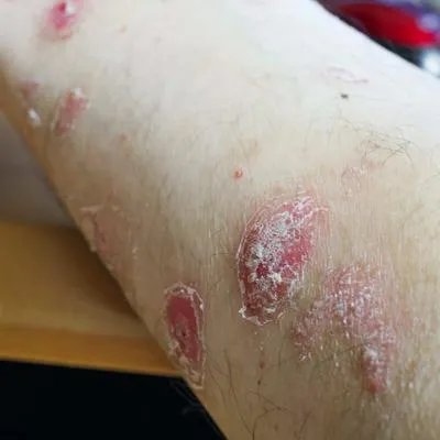 牛皮癣药会引起血小板降低吗