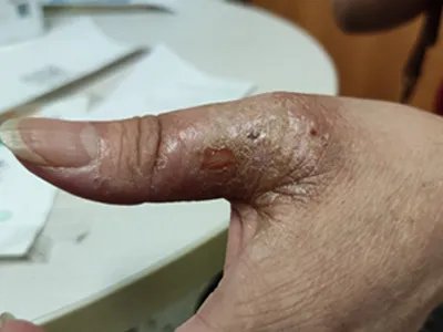 慢性湿疹腿症状图片