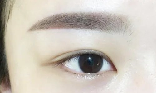 三点定位双眼皮要多久