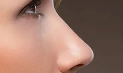 隆鼻假体修复是永久吗