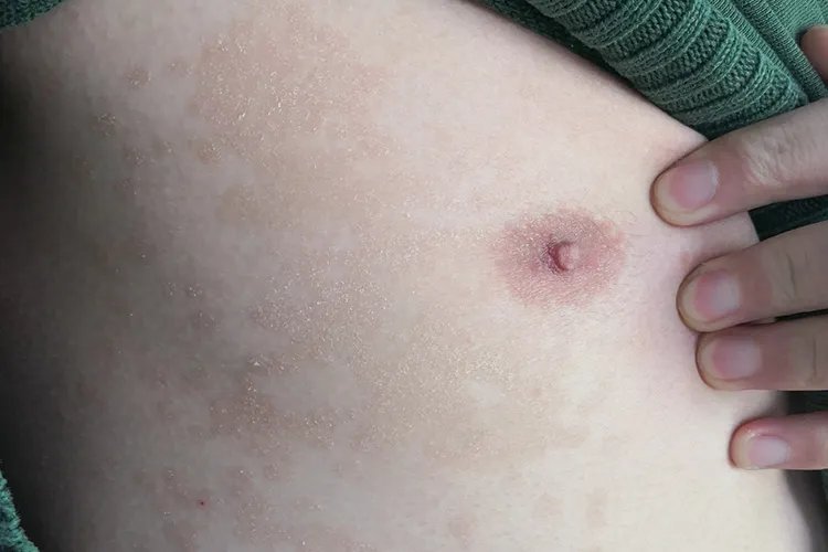 汗癣的症状图片