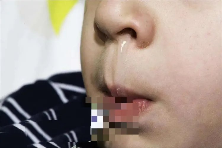 生漆过敏的症状图片