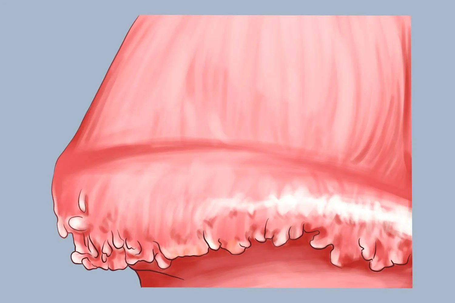 冠状珍珠丘疹图片大全