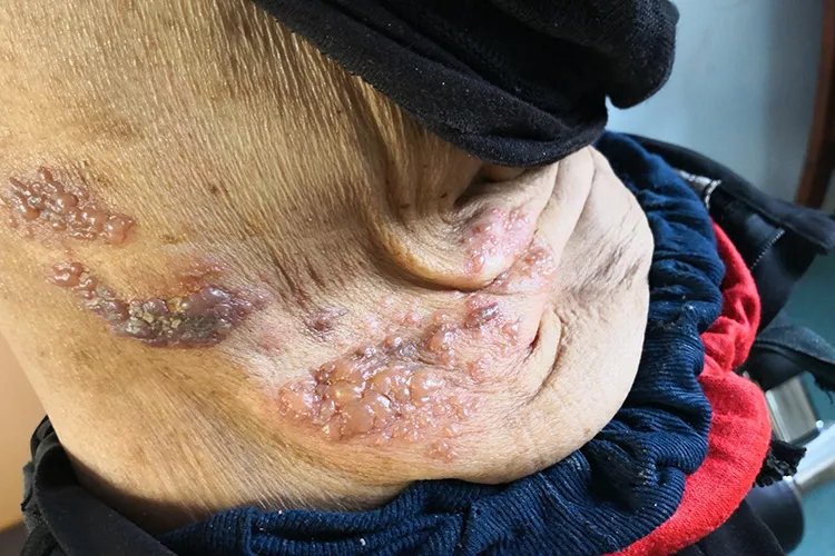 带状疱疹的症状图片