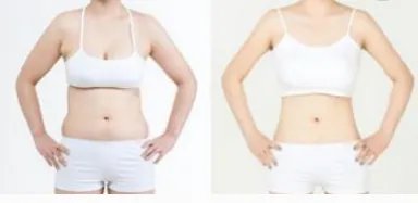 溶脂减肥手术的步骤是怎样的