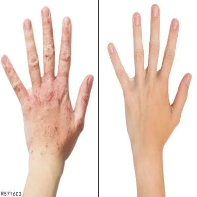 风湿有什么危害  风湿的不良影响