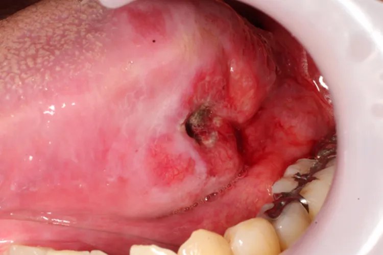 舌癌的早期症状图片