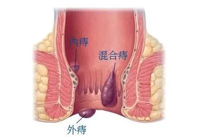得痔疮的图片