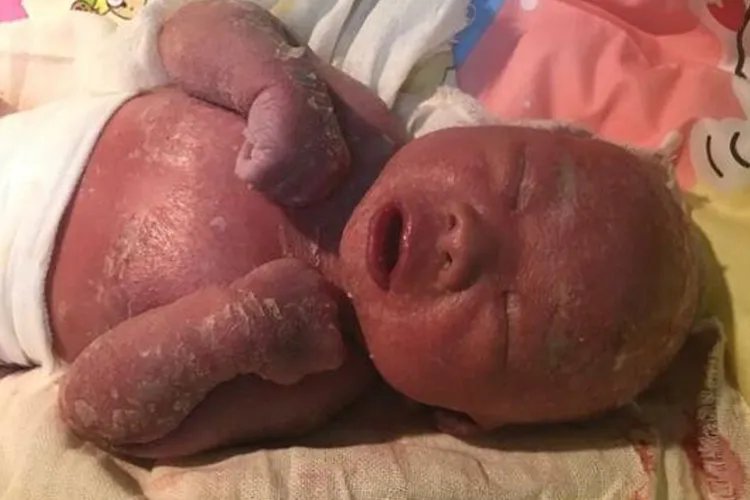 火棉胶婴儿图片