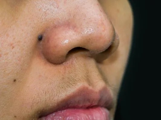 如果点痦子会留疤吗