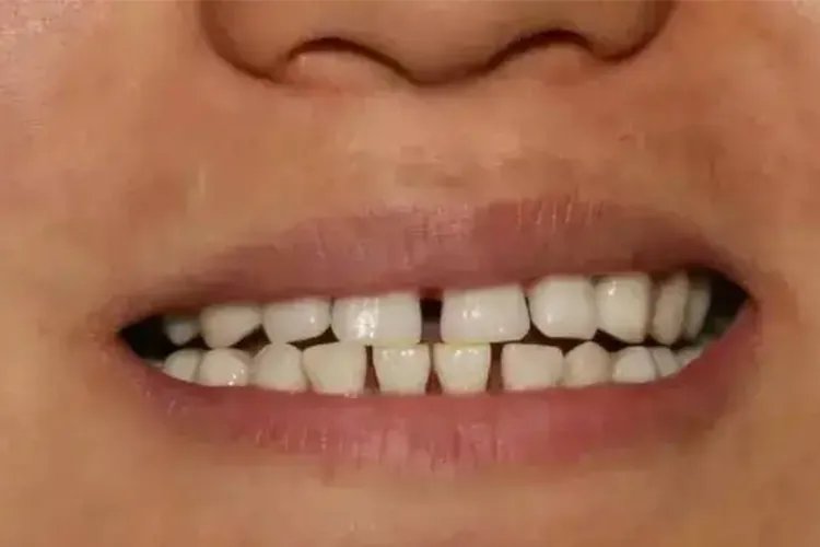 牙齿不整齐图片