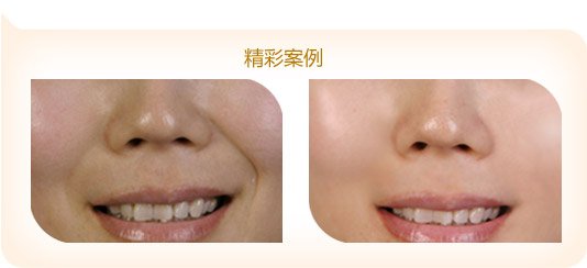 玻尿酸注射鼻唇沟除皱的价格大概多少