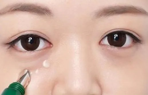 自体脂肪填充泪沟多少钱