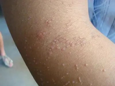 疣状表皮发育不良症状图片