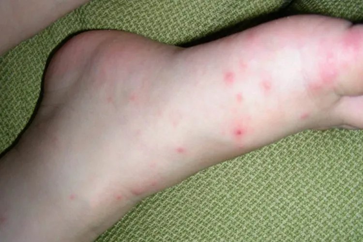 手足口病轻微症状初期图片