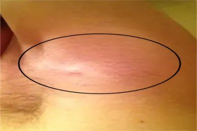 腋下淋巴瘤图片大全