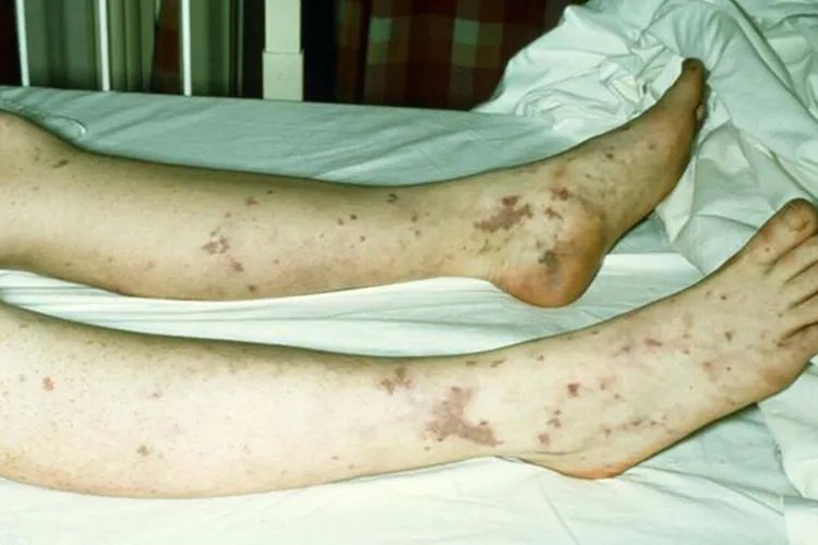 白血病初期小红点图片