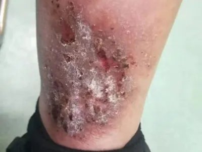 慢性湿疹腿症状图片