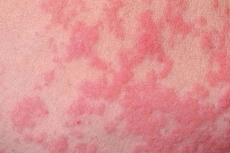 白血病初期小红点图片