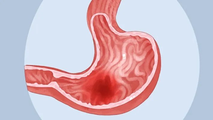 CA125是什么意思