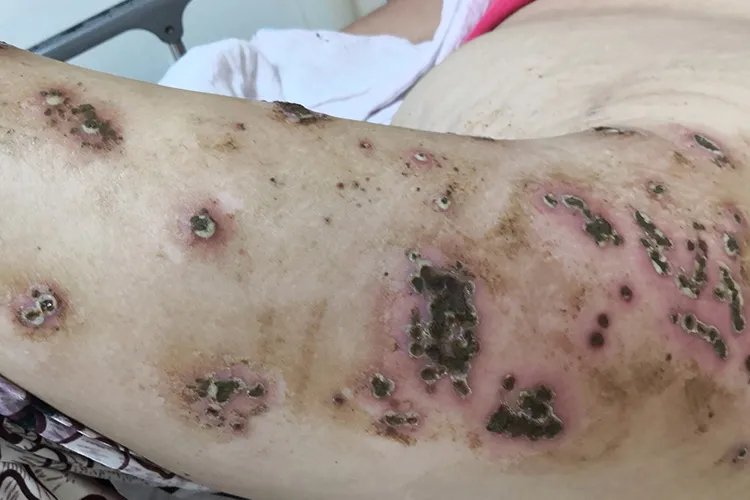 带状疱疹的症状图片