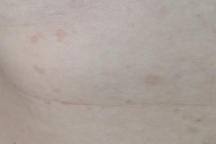 汗癣的症状图片