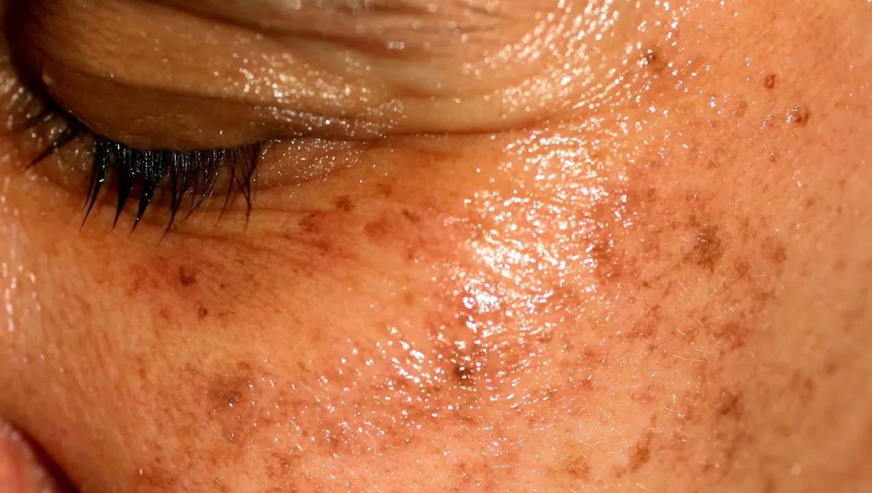 黄褐斑与雀斑的区别