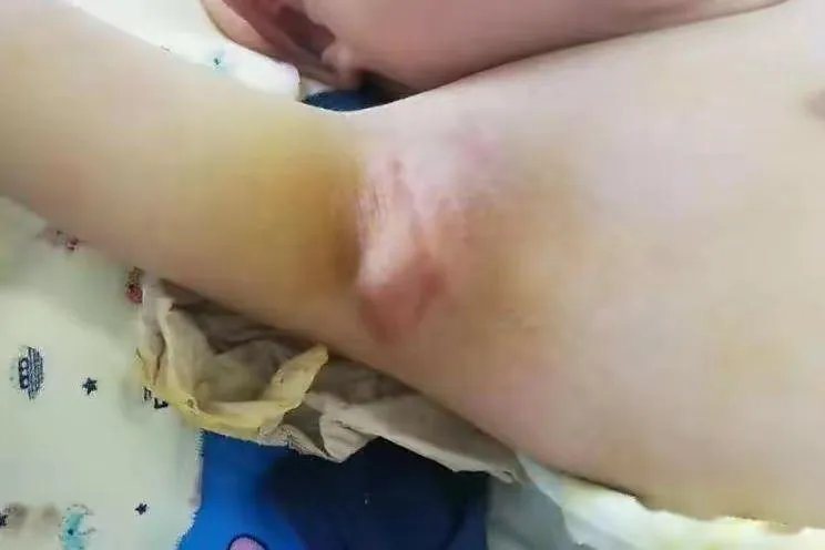 腋下淋巴瘤图片大全