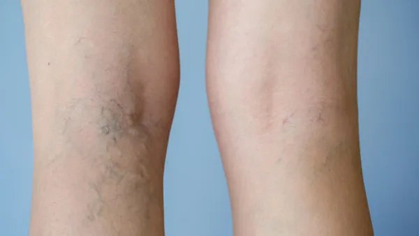 脉管炎怎么治疗好