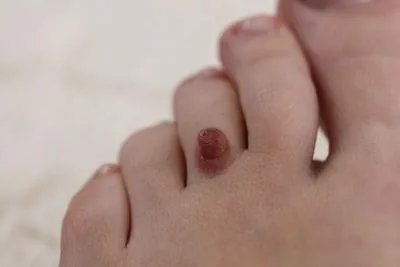 除痣后为什么会再长 除痣后再长的原因细说