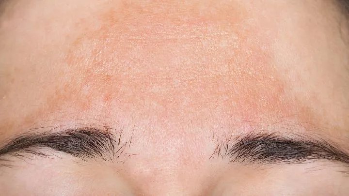 中医黄褐斑专家怎样治疗黄褐斑？