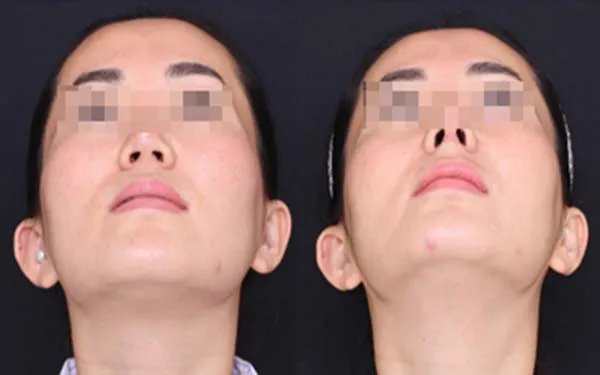 2021上海联合丽格医疗美容隆鼻价格表(价目表)怎么样?