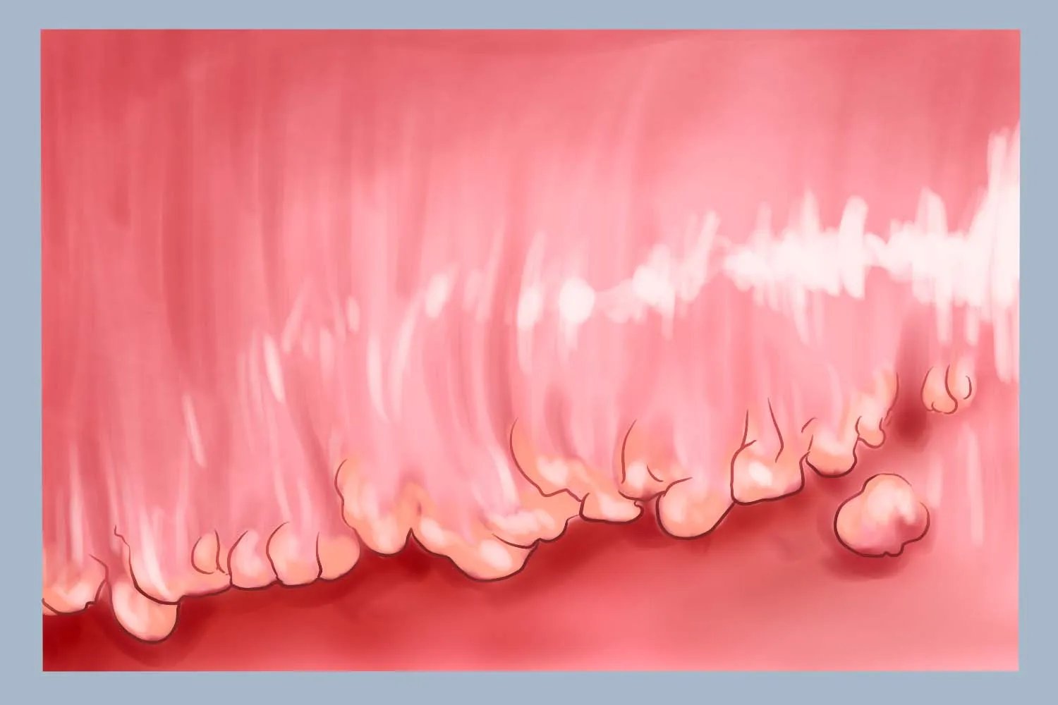 冠状珍珠丘疹图片大全