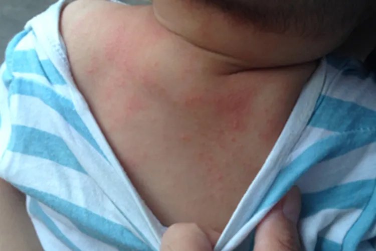 婴儿皮疹图片