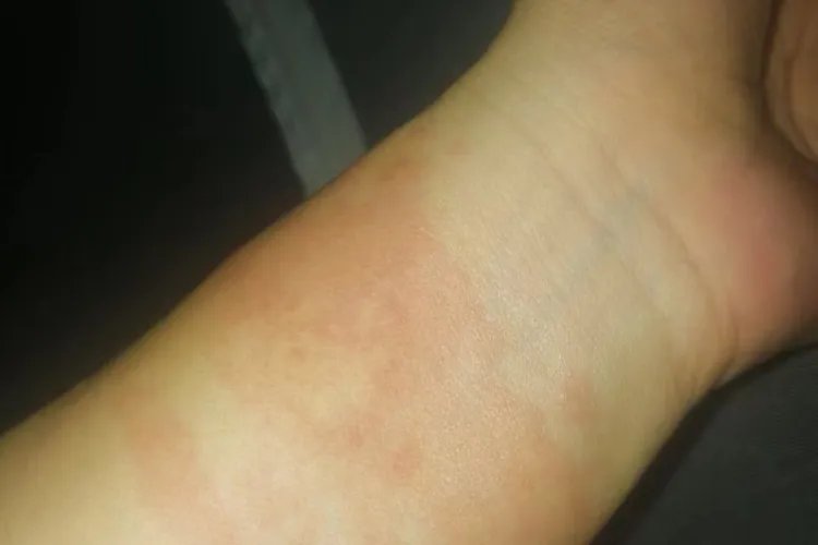 生漆过敏的症状图片