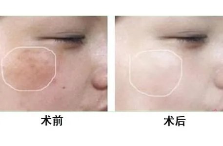 镭射祛斑多少钱