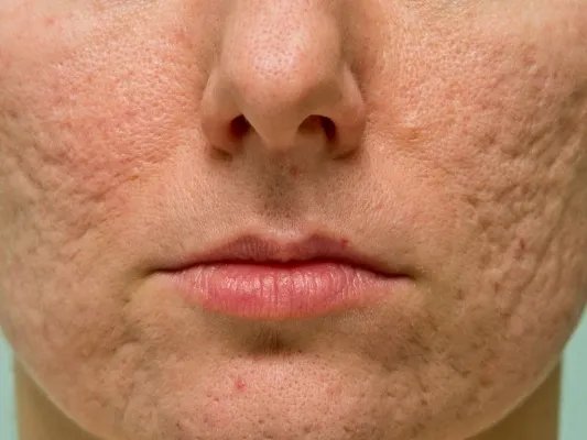 果酸换肤可以去痘坑吗