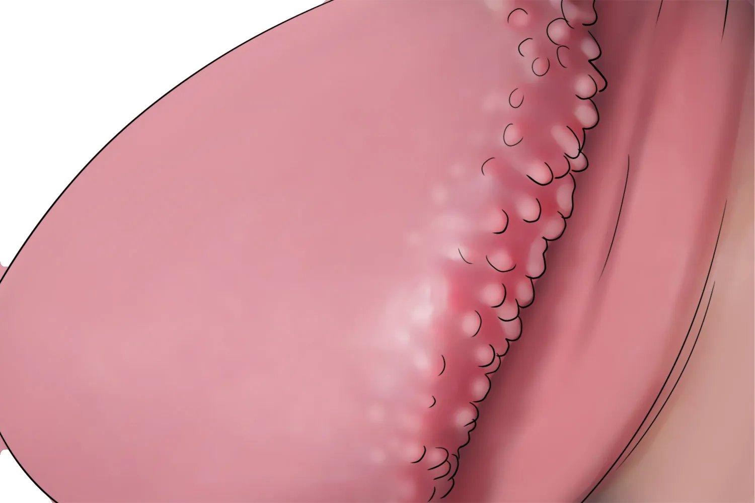 冠状珍珠丘疹图片大全