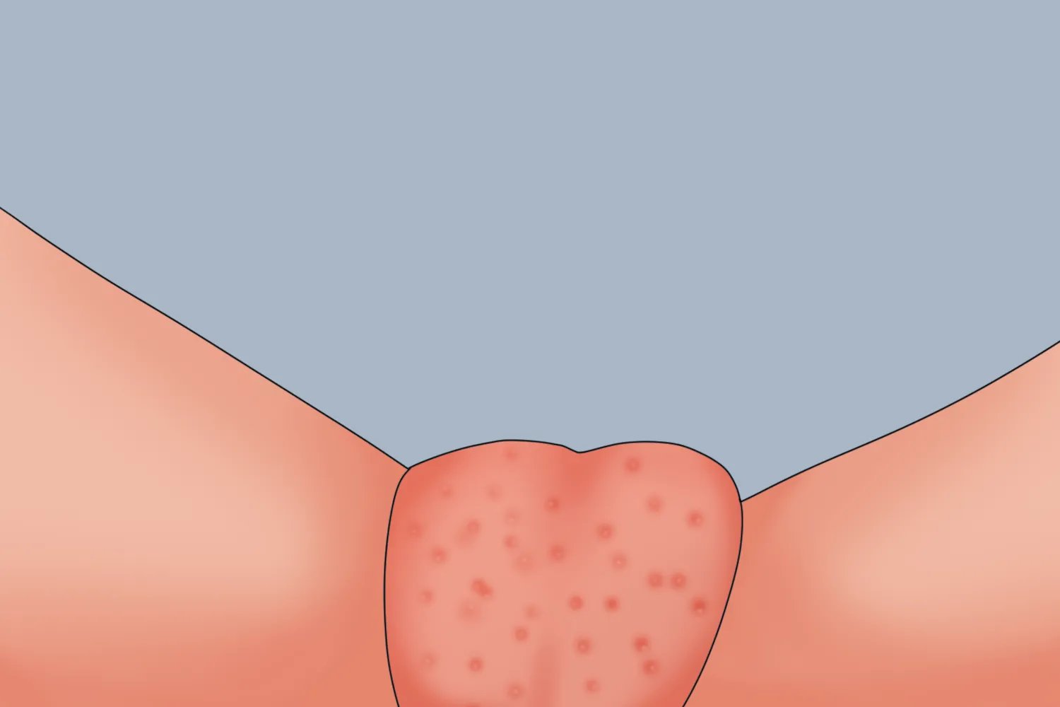 阴囊湿疹初期图片
