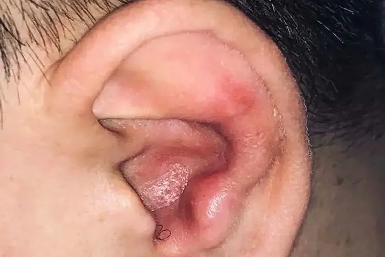 带状疱疹的症状图片