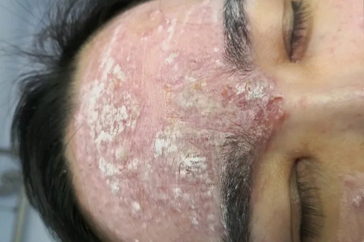 带状疱疹的症状图片