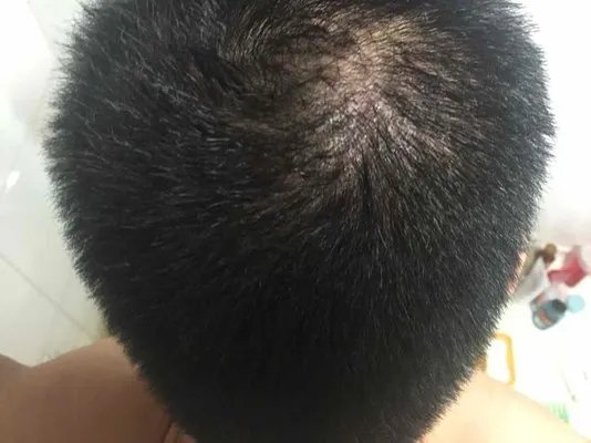 防脱发洗发水哪个好?