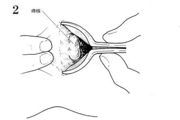 痔疮外剥内扎术图解