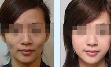 玻尿酸丰脸价格多少