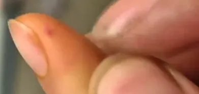 住宾馆遭老鼠咬伤怎么办？