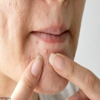 为什么脸部会长痤疮